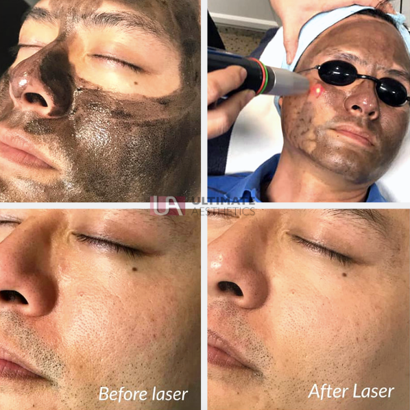 Revlite cheap laser facial