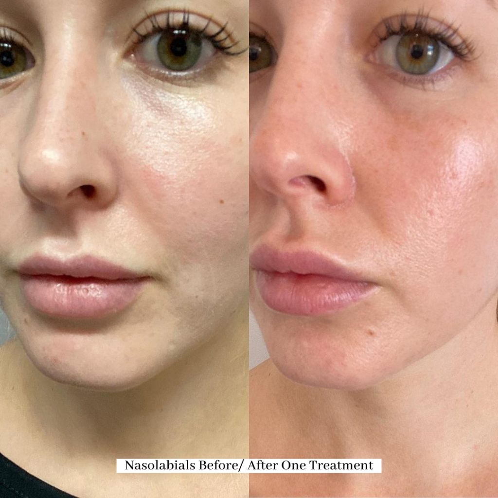 PRP Vampire Facial | Ultimate Aesthetics